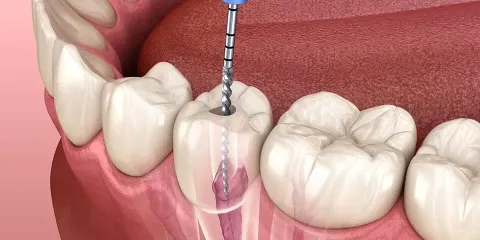 Root Canal Guide: Endodontic Procedures, Treatment Stages, and Dental Care