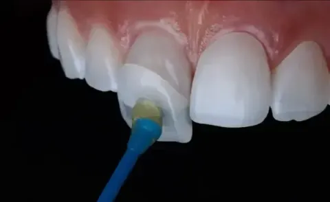 Dental Veneers Guide: Cosmetic Procedures, Materials, and Oral Care