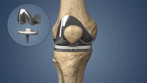 Knee Replacement Guide: Joint Surgery, Implant Options, and Recovery Planning