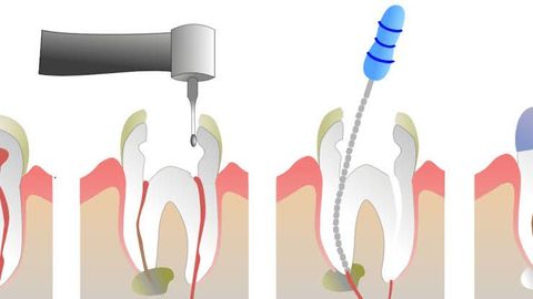Root Canal Guide: Endodontic Procedures, Treatment Stages, or Dental Care