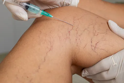 Varicose Vein Treatment Guide: Procedures, Recovery, and Vascular Care