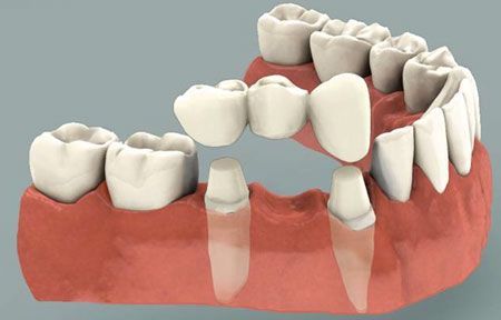 Dental Bridge Guide: Replacement Options, Treatment Procedures, and Oral Health