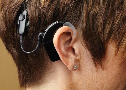 Hearing Implant Guide: Implant Technology, Procedures, and Hearing Rehabilitation