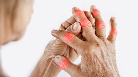 Arthritis Pain Management Guide: Treatment Approaches, Therapy Options, Medications, and Care Planning